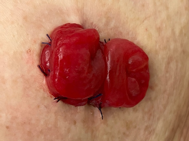 Verzorging ileostoma met een tweedelig opvangsysteem