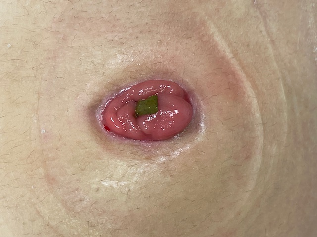 Verzorging colostoma met een tweedelig opvangsysteem