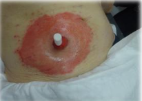 De preventie en behandeling van irritatieve contactdermatitis bij stomadragers