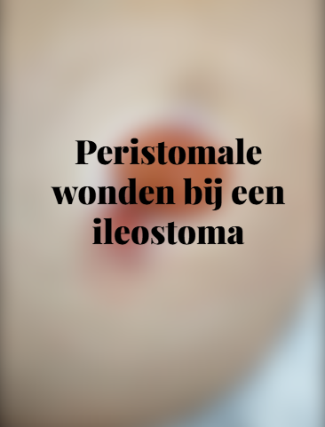 Peristomale wonden bij een ileostoma