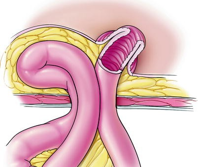  Nederlands onderzoek naar preventie van parastomale hernia's